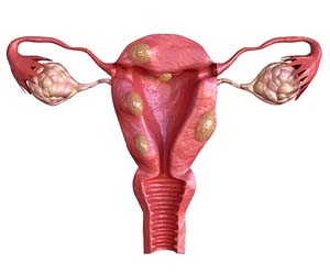 Uterine Fibroid Treatment